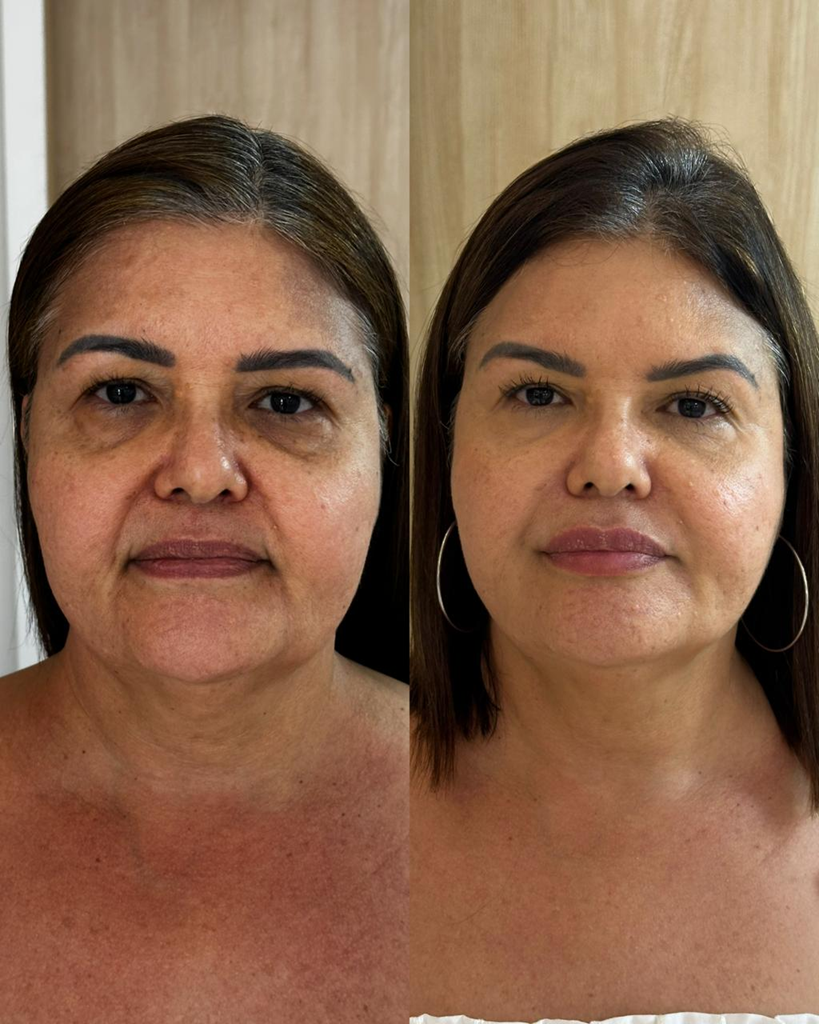 Resultado de tratamento Método Suavize 2