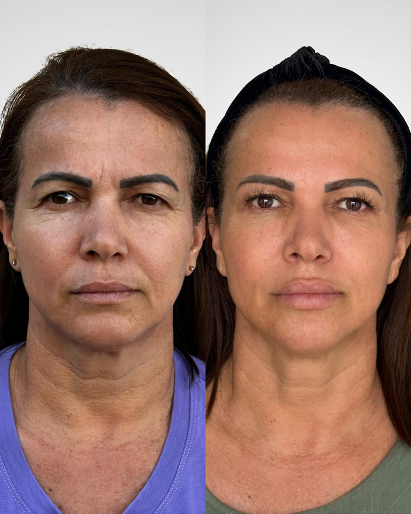 Resultado de tratamento Método Suavize 3