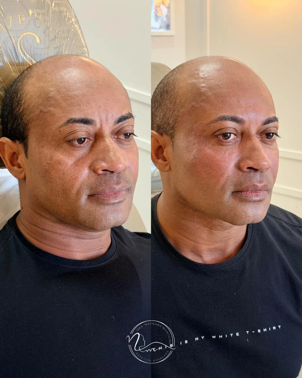 Resultado de tratamento Rejuvenescimento Facial 2