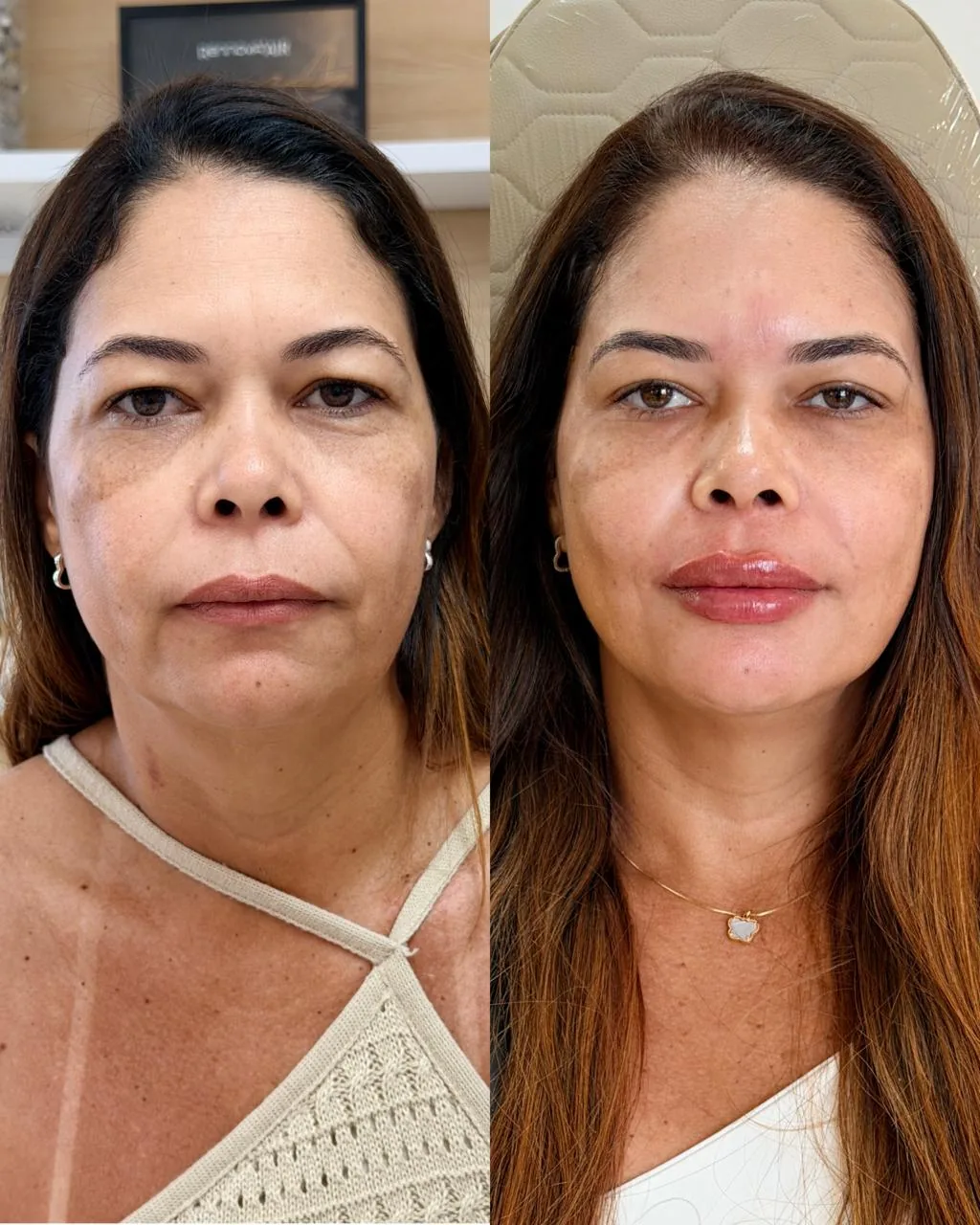 Resultado de tratamento Rejuvenescimento Facial 3