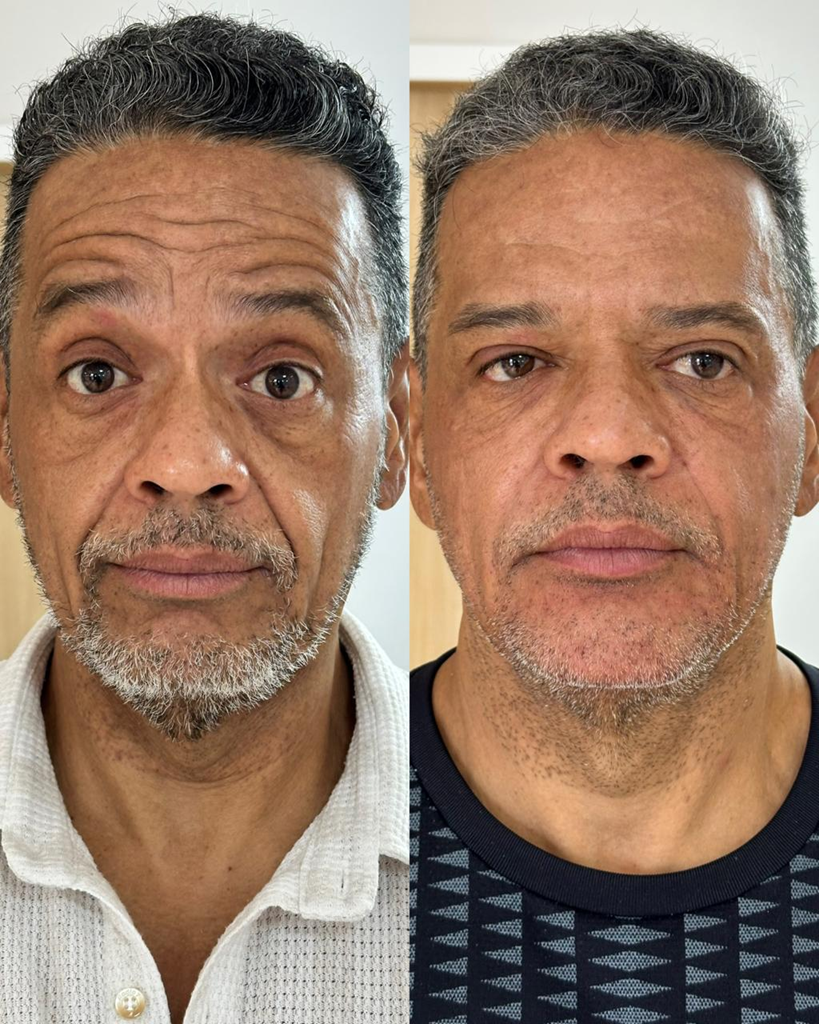 Resultado de tratamento Rejuvenescimento Facial 4