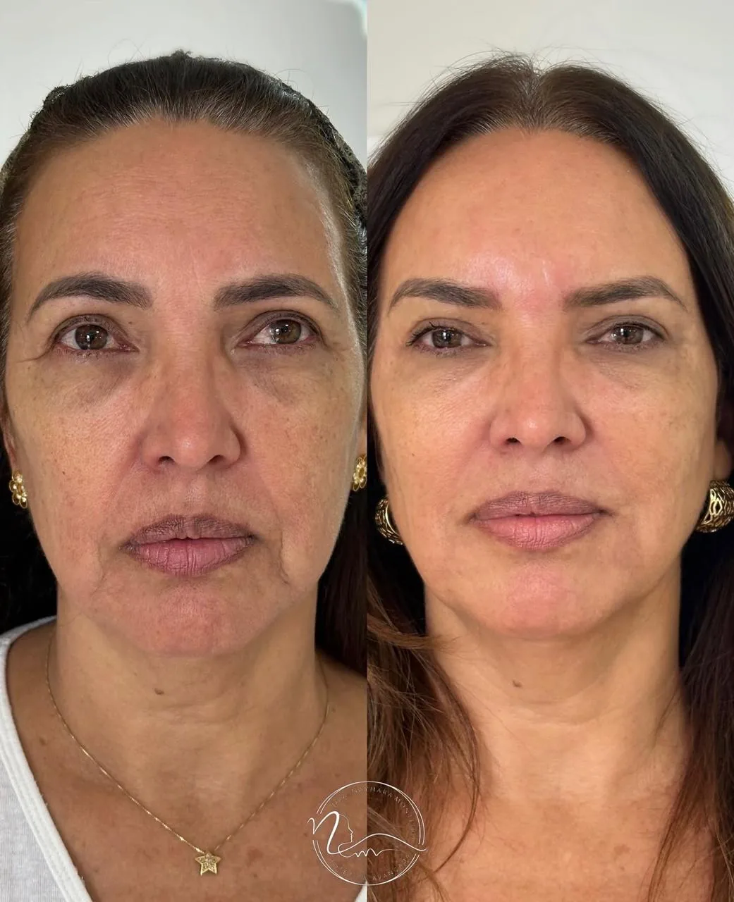 Rejuvenescimento Facial